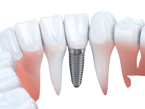 dental implant cost in pakistan