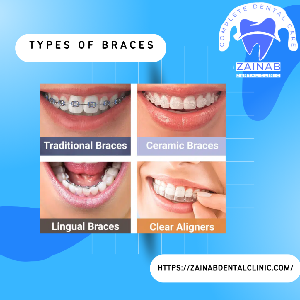 Teeth Braces Price in Pakistan